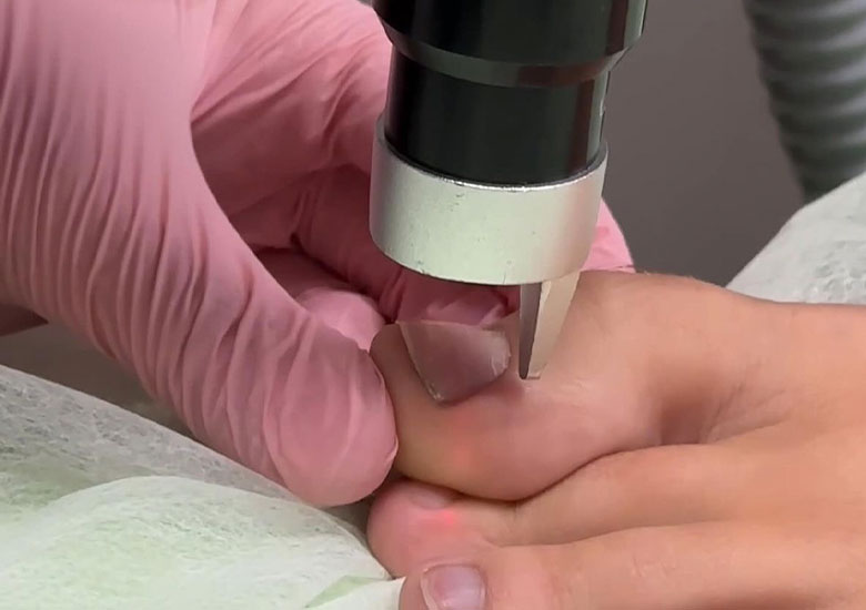 Eliminación de Hongos en Uñas de los Pies con Láser ND-YAG - Andreas Clínica Estética